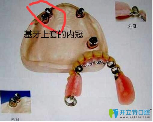 套筒冠附著體