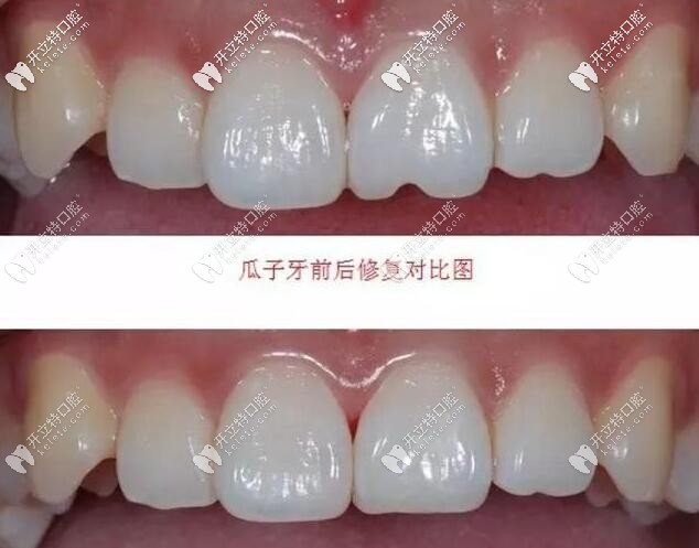 樹脂材料修復(fù)瓜子牙前后對比圖