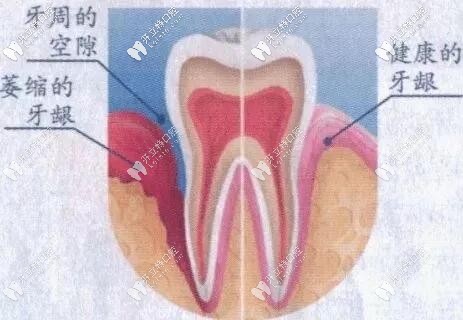 牙齦對比圖