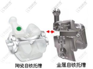 自鎖托槽圖片