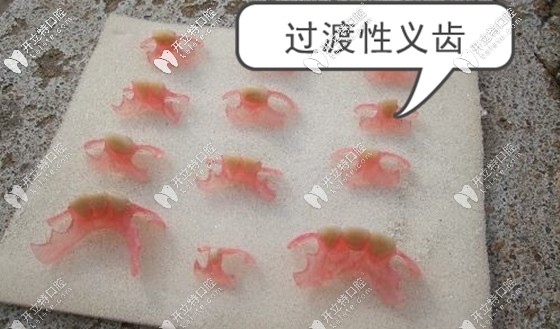 誰知道種植牙的過渡義齒能用多久呢?若長期佩戴可以嗎？