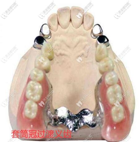 套筒冠義齒