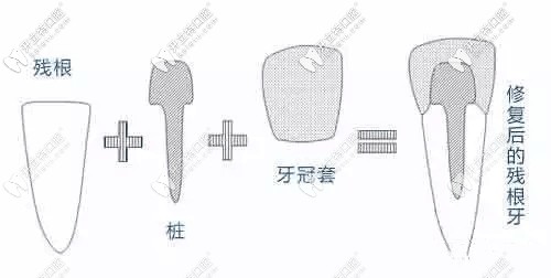爛牙根修復(fù)后圖示
