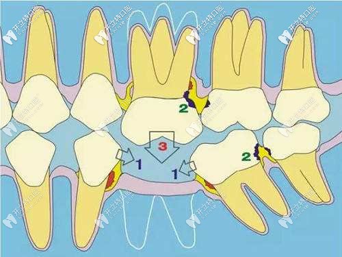 爛牙根不拔后果