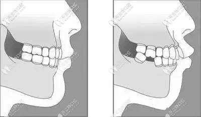 爛牙根拔除后圖片
