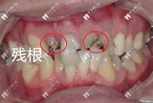 牙齒殘根圖片