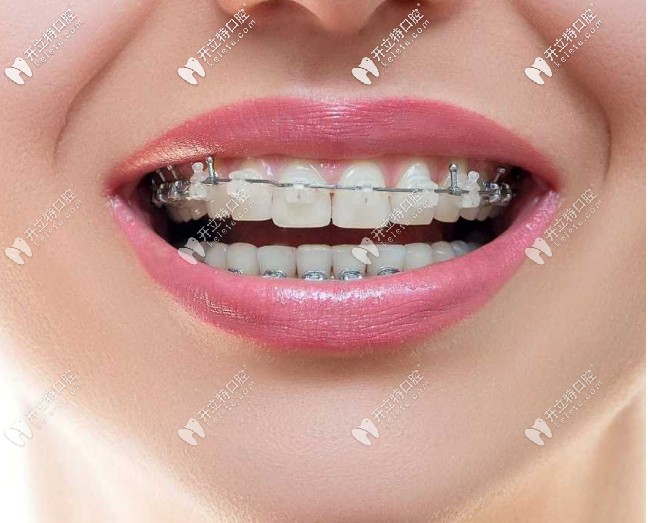 什么是陶瓷半隱形牙套