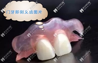 門牙即刻義齒圖片