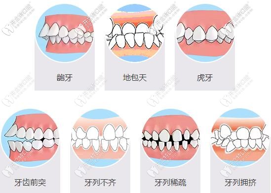 牙齒畸形對(duì)我們的影響很大