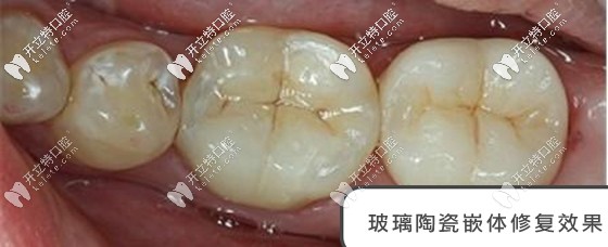 玻璃陶瓷材料修復口內照