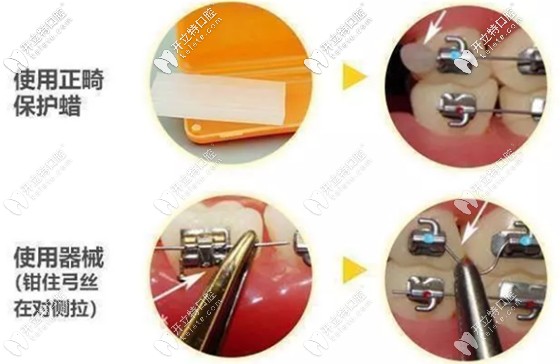 對(duì)于正畸鋼絲滑出的處理方法