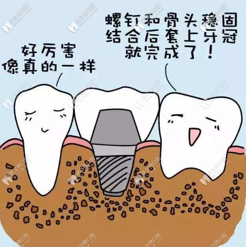 等骨愈合后安裝牙冠
