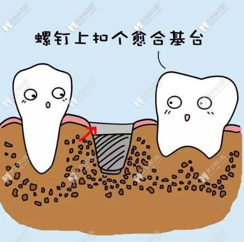 種植牙二期安裝愈合基臺(tái)