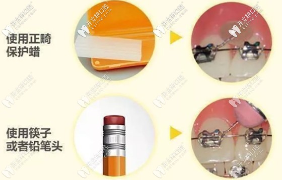 結(jié)扎絲露出扎嘴的處理方法