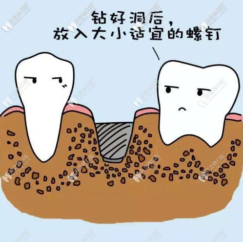 種植牙需要先鉆洞