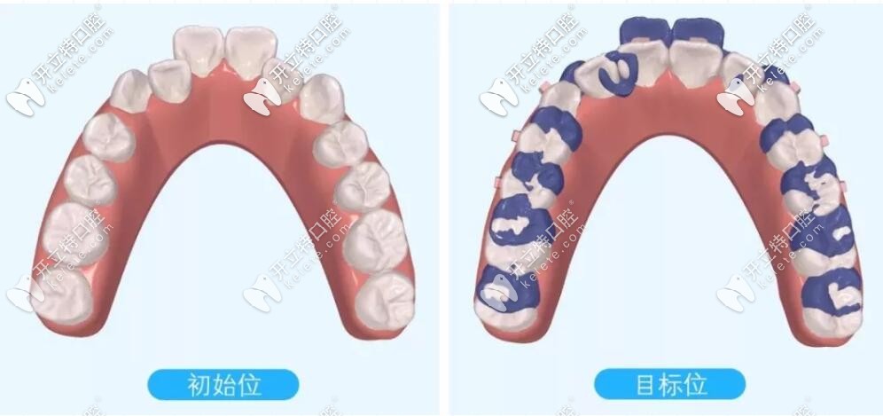 磨牙后推示意圖