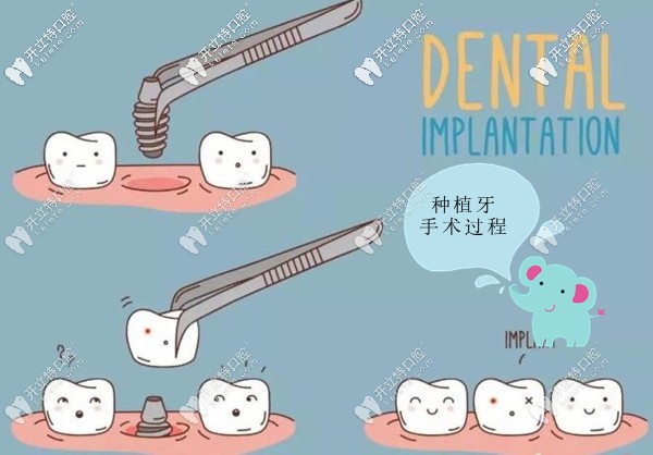 微創(chuàng)種植牙手術(shù)過程圖解