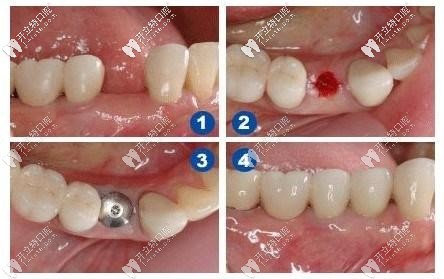 微創(chuàng)種植牙步驟圖解