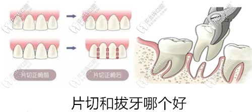 片切和拔牙哪個(gè)好