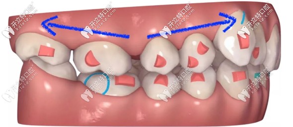 在推磨牙過程中前牙也會有向前的力量