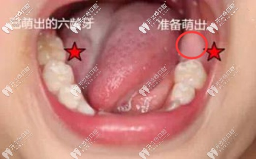 兒童準(zhǔn)備萌出六齡齒時的牙齦容易腫脹