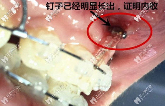 支抗釘?shù)氖姑瓿删鸵∠聛砹? border=