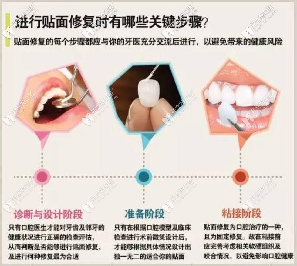 做牙齒貼面設(shè)計(jì)要點(diǎn)