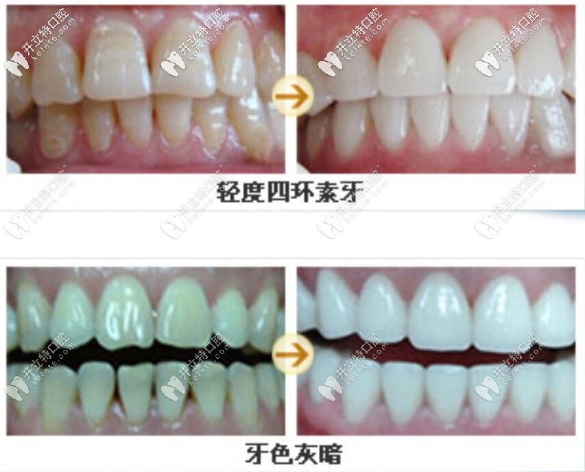 瓷貼面前后對(duì)比