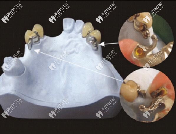 栓道式精密附著體義齒