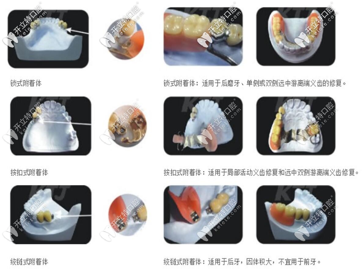 不同精密附著體義齒的適應(yīng)癥