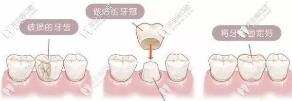 解答：門牙缺了一小塊是選牙齒貼面還是全瓷牙好呢？