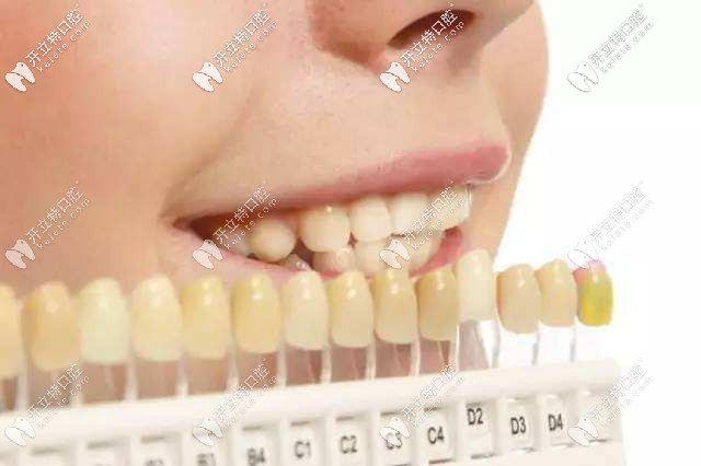 牙齒貼面色調(diào)對(duì)比 牙齒貼面色調(diào)對(duì)比