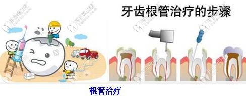 牙齒根管治療的步驟