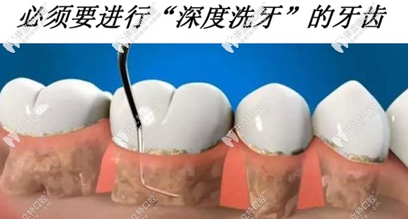 深度潔牙主要針對重度牙周病