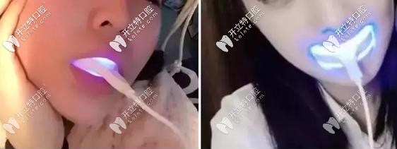 美牙儀會(huì)導(dǎo)致牙齦萎縮