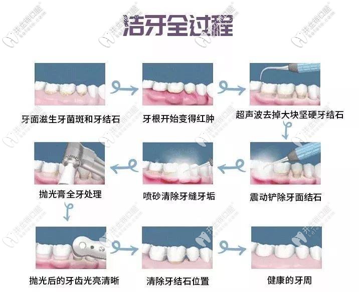 洗牙全過(guò)程圖