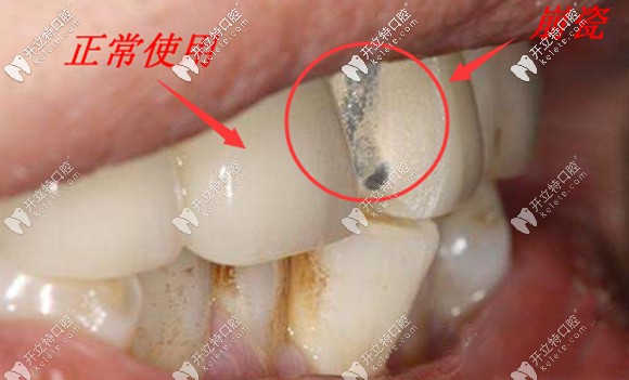 牙冠的合理設(shè)計(jì)也是影響使用壽命的重要因素