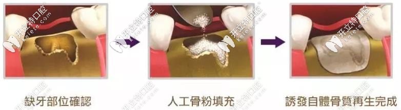 植骨粉種植牙過程