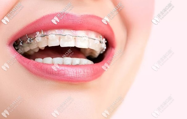 半隱形陶瓷托槽牙套