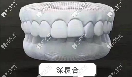 牙齒深覆合也是咬合不良的一種病癥