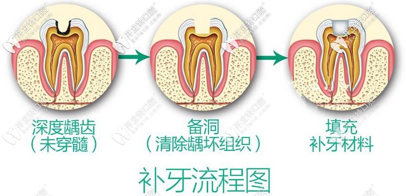補(bǔ)牙攻略：3m和德國(guó)voco納米樹(shù)脂補(bǔ)牙哪個(gè)材料更好？