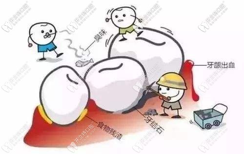 潔牙可以去除食物殘渣和牙結(jié)石