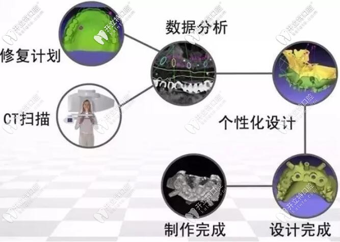 3d導(dǎo)板種植牙過程