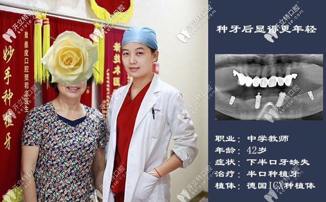 這次在廣州做的德國ICX半口種植牙挺滿意的,價(jià)格也美