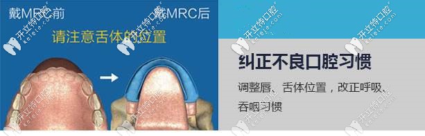 MRC矯正可以糾正不良口腔習(xí)慣