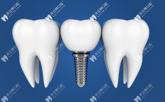 沈陽米蘭齒科種植體特點