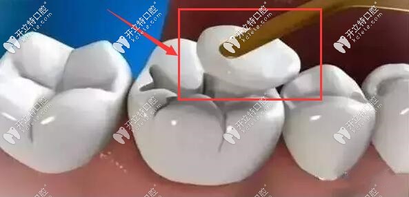 補(bǔ)牙材料的大小不合適