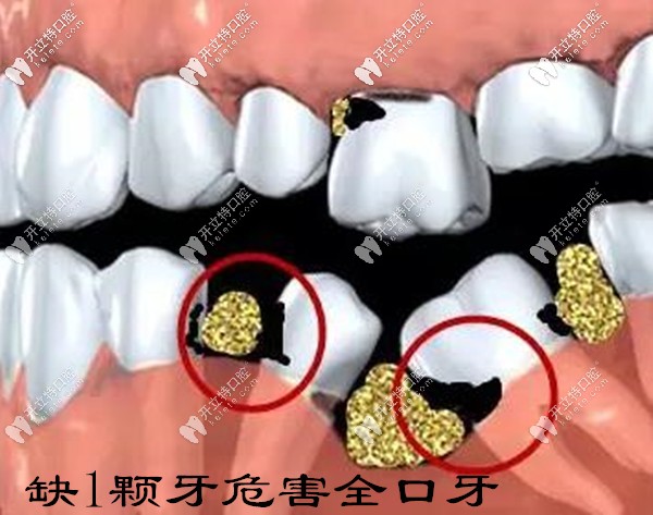 缺一顆牙不補(bǔ)會(huì)危害全口健康牙齒