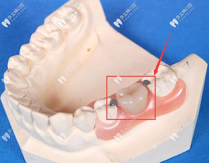 活動(dòng)假牙修復(fù)單顆牙缺失