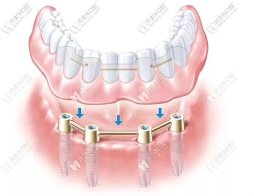All-on-4全口種植牙示意圖
